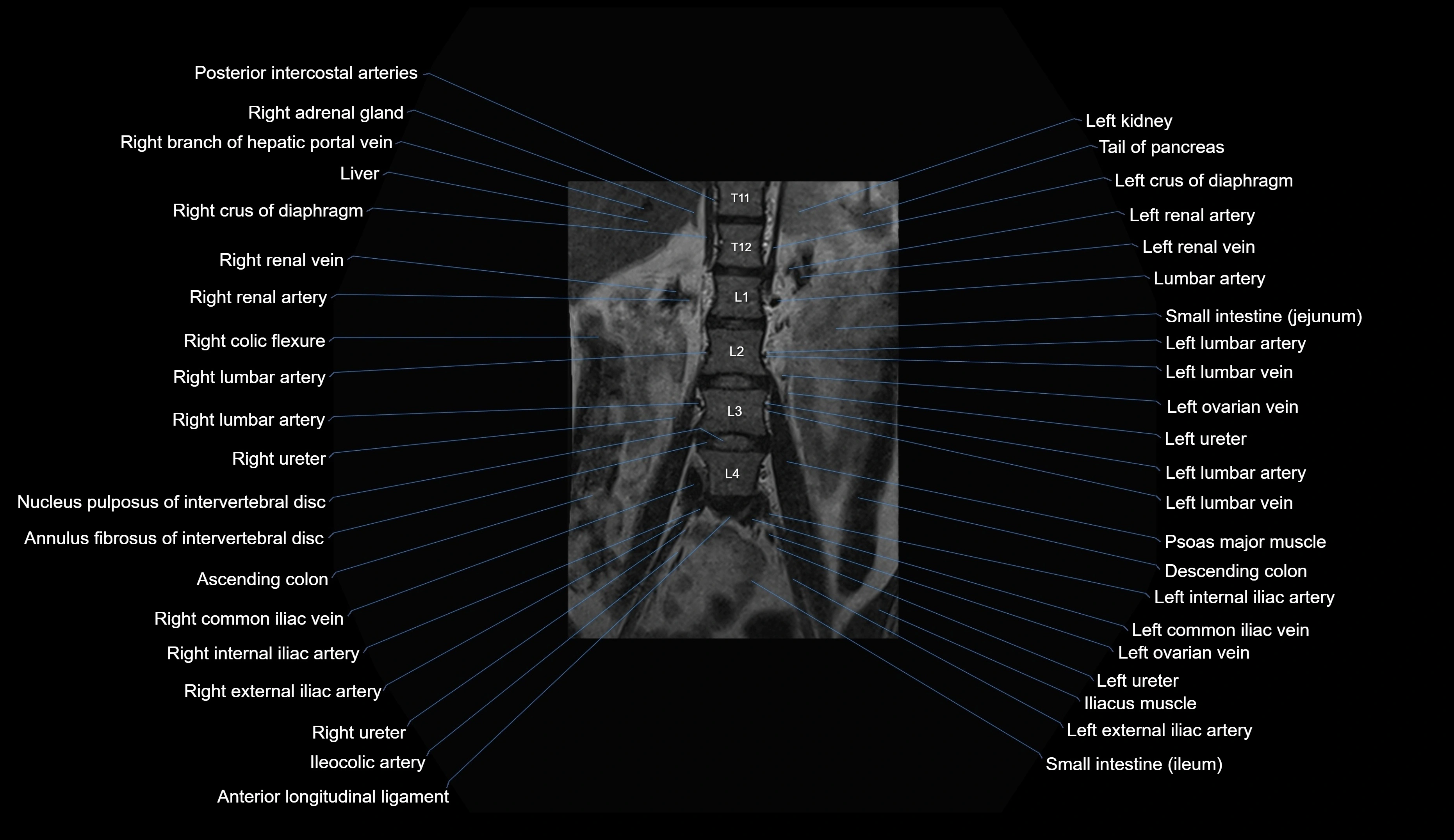 MRI lumbar spine coronal cross sectional anatomy 3T radiology  image-img-00001-00007.webp